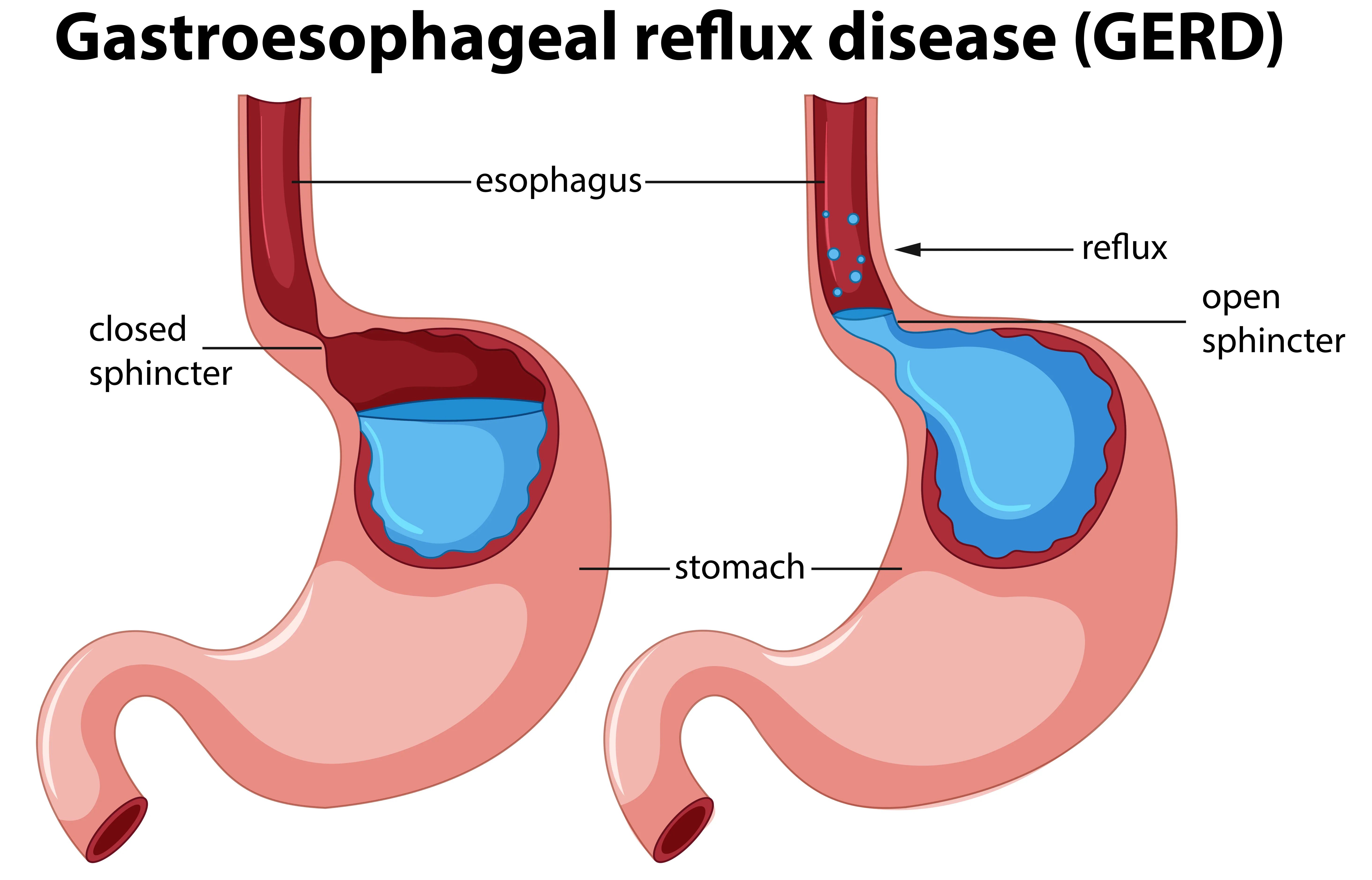 GERD Pathophysiology Diagram