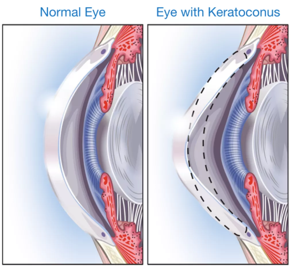 Diagram comparing a normal cornea with a keratoconic cornea