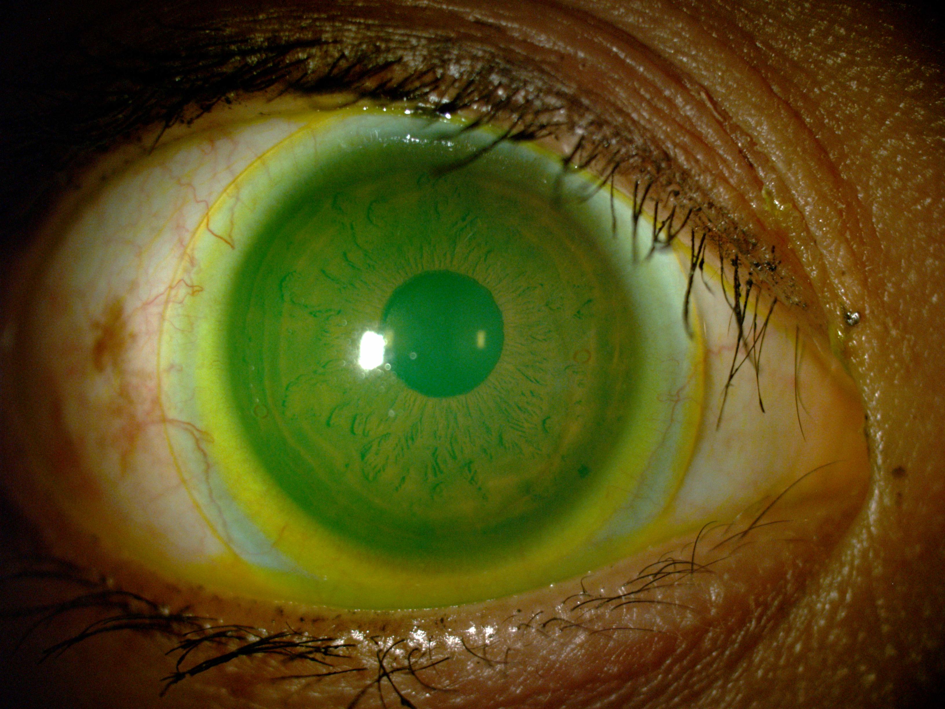 Scleral lens evaluated with fluorescein