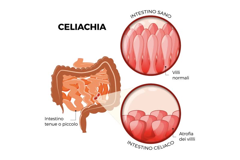 Celiachia: intestino sano vs intestino celiaco