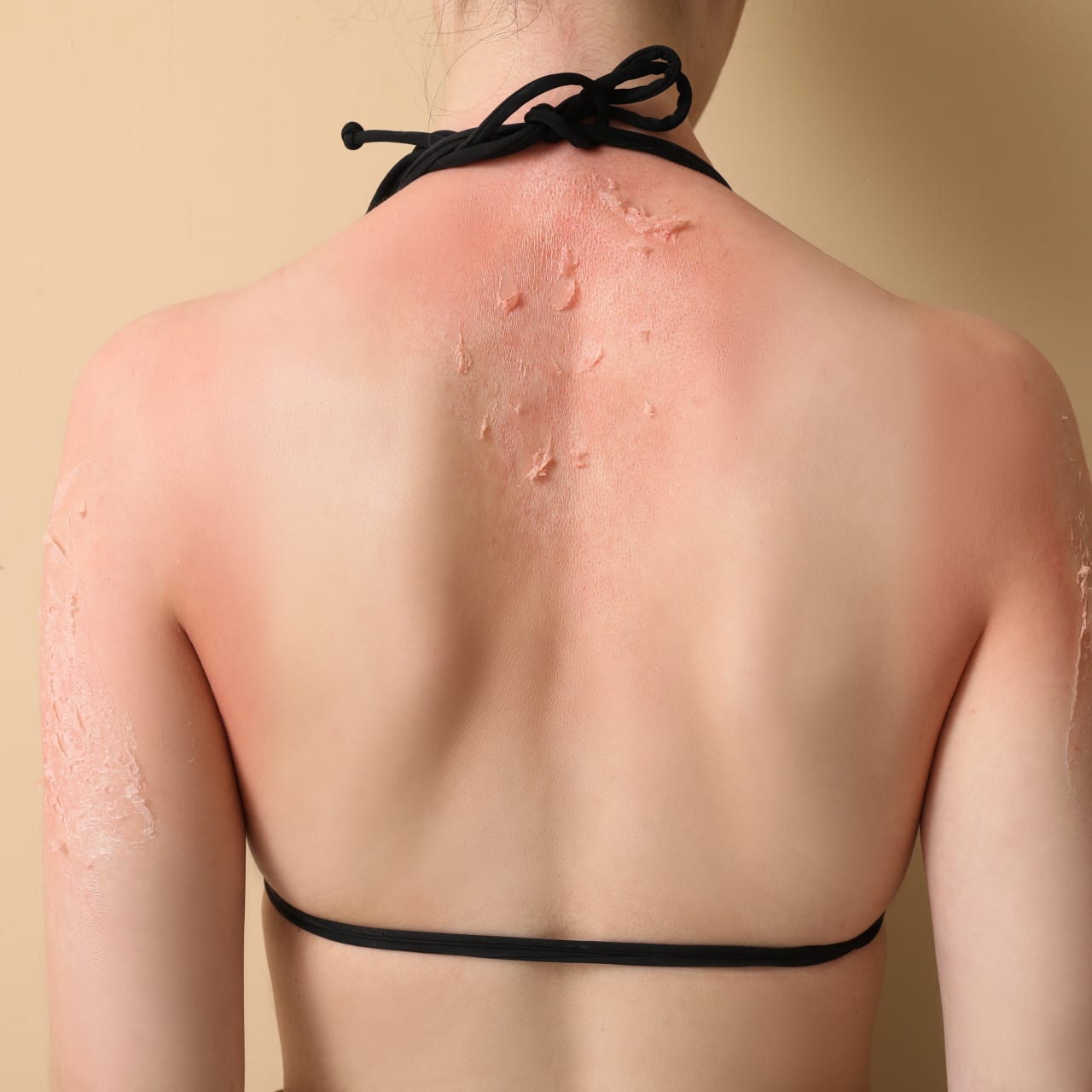 Allergie cutanée - rougeurs