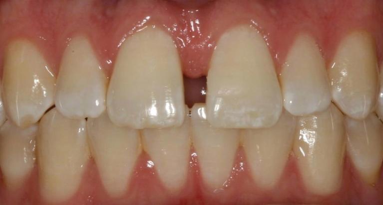 Diastema medio: espacio visible entre los incisivos centrales superiores en evaluación clínica.