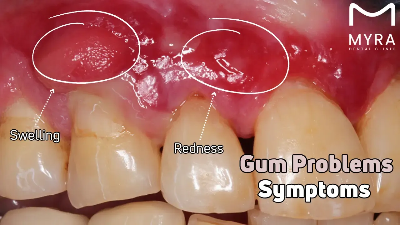 Bleeding gums problem