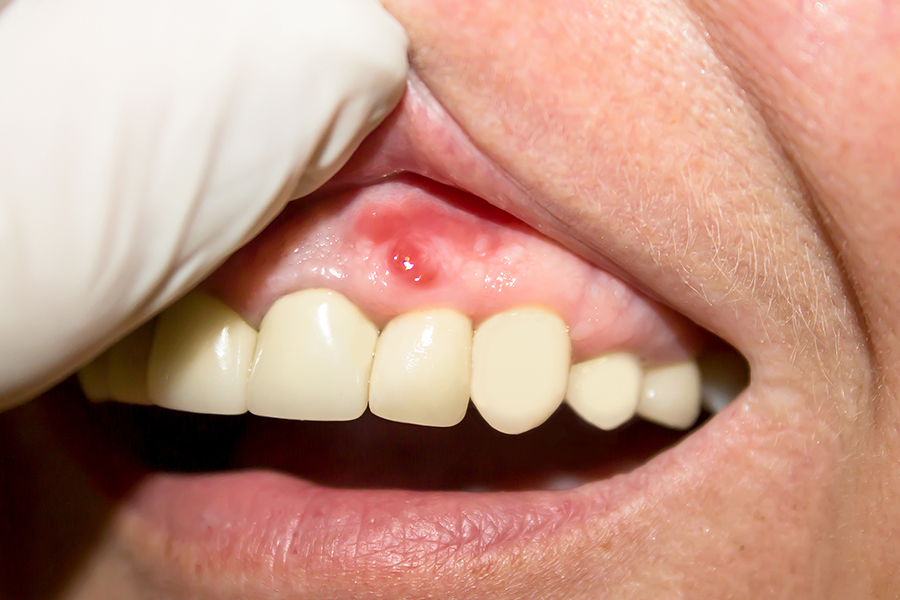 Bad breath embarrassing moment